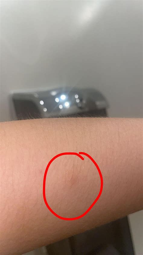 Painful Lump On Forearm Under Skin at Simona Brown blog