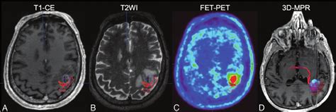 Image result for Contralateral Weakness