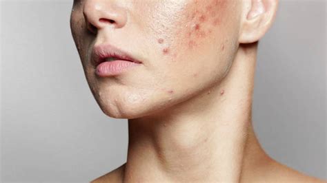 Skin Acne Treatment in Pune - SkinAngel