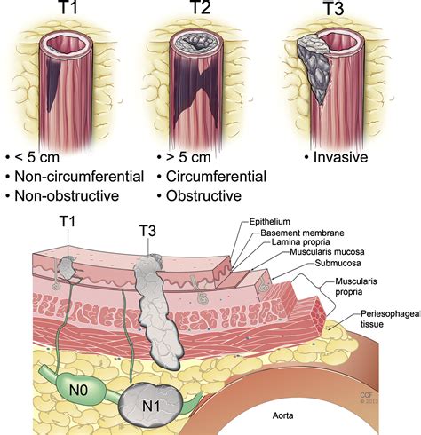Esophageal Cancer Staging - Thoracic Surgery Clinics