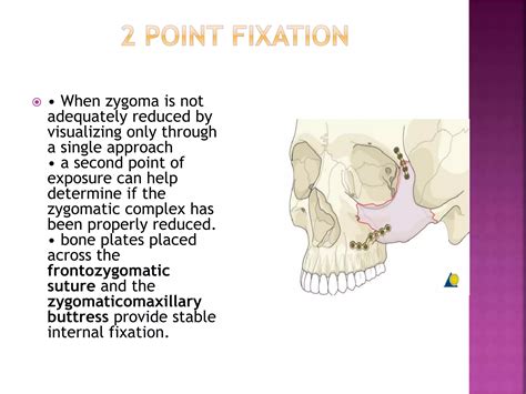 Zygomatic complex fracture | PPTX
