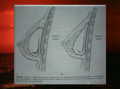 1.Augmentation & reduction mammoplasty (2).pptx
