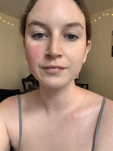 Does anyone else only get one cheek? Been having flare-ups with small red bumps on my right ...