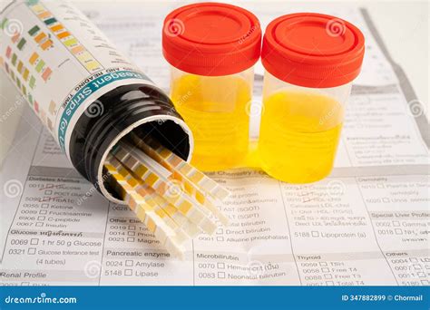 Urinalysis, Urine Cup with Reagent Strip PH Paper Test and Comparison ...