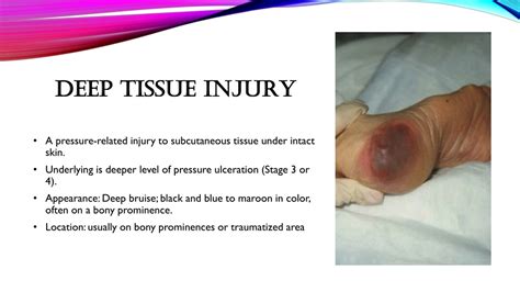 PPT - Improving Documentation for Pressure Ulcer Coding PowerPoint ...