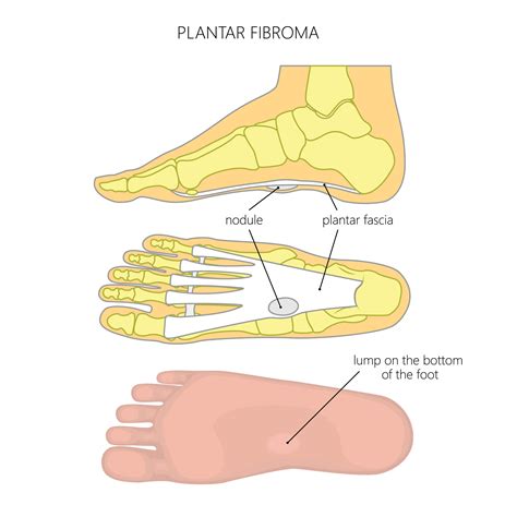 Plantar Fibromas — LIGHTHOUSE FOOT & ANKLE CENTER