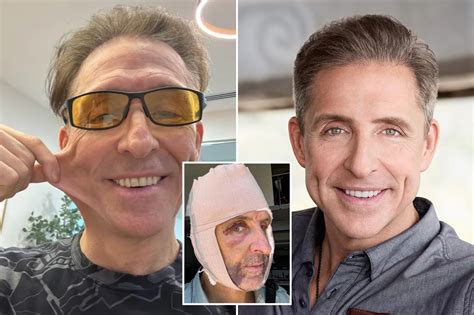 Do straws actually cause lip wrinkles? A plastic surgeon reveals the answer