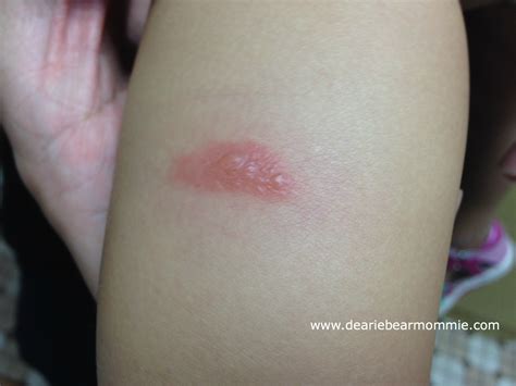 Mosquito Bite Baby Reaction at Mia Fortune blog