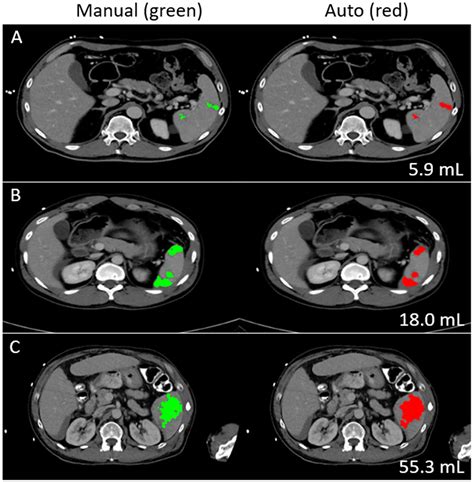 Toward automated interpretable AAST grading for blunt splenic injury - PMC