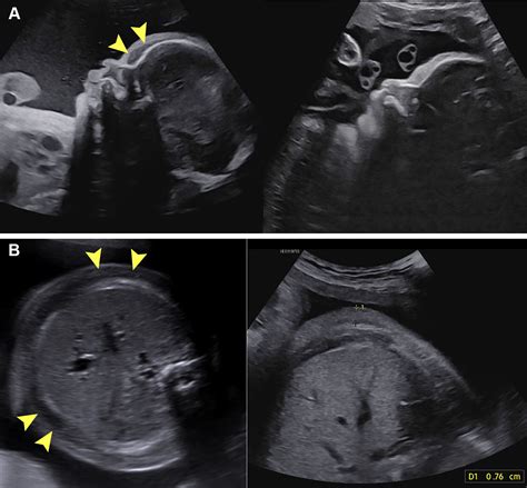Differential Diagnosis of Hydrops Fetalis: An Imaging GuideRadioGraphics