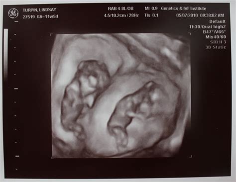 Adventures in Baby Making: 12 weeks ultrasound