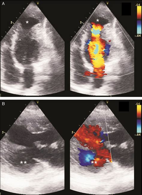 Multiple left ventricular aneurysms in a young female | Revista ...