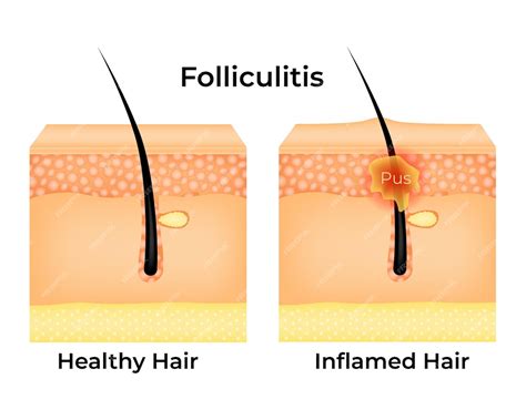 Premium Vector | Folliculitis health hair and inflamed hair vector illustration