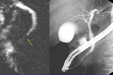 Image result for Abnormal MRCP