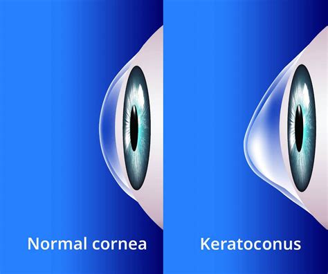 Keratoconus Treatment - Expert Care to Improve Your Vision
