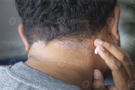 Eczema Scalp Black People