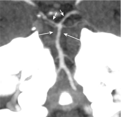 Reversible cerebral vasoconstriction syndrome after neostigmine and ...