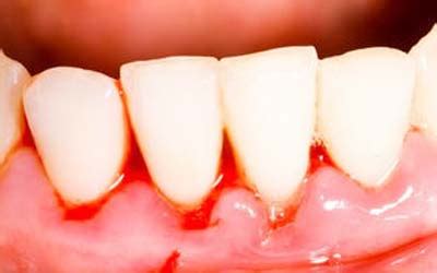 如何鉴别牙龈出血的原因_济南齐鲁花园医院