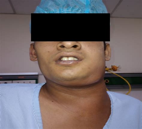 Anesthetic challenges in a patient of atypical Ludwig’s angina - Indian ...