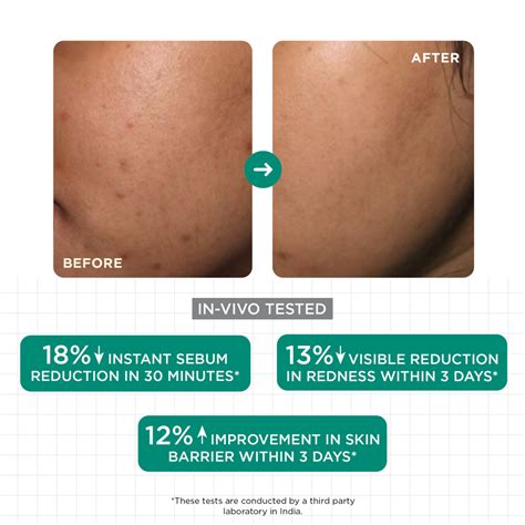 Best Face Serum for Oily & Acne-Prone Skin - SkinQ