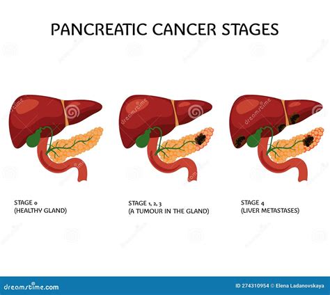 Cancer Du Pancreas – Cancer Du Pancréas Causes Principales – PSFLM