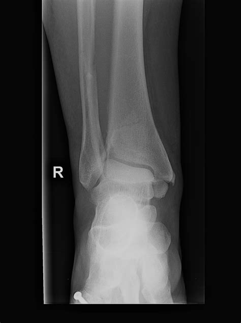 Trimalleolar ankle fracture | Image | Radiopaedia.org