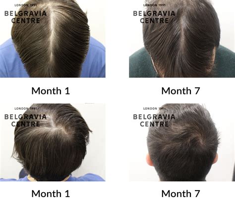 Hair Growth 3 Weeks at Shanita Matheny blog