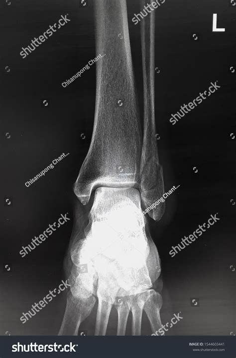 Film Xray Ankle Lateral Showed Fracture Stock Photo 1544603441 ...
