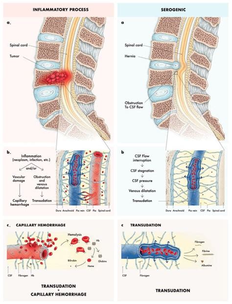 Froin’s Syndrome: A Comprehensive Review of the Literature and the ...