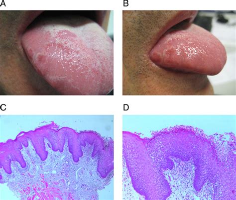 Geographic tongue and tenofovir | BMJ Case Reports