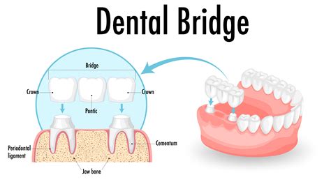 Dental Bridges in Singapore | Thomson Medical