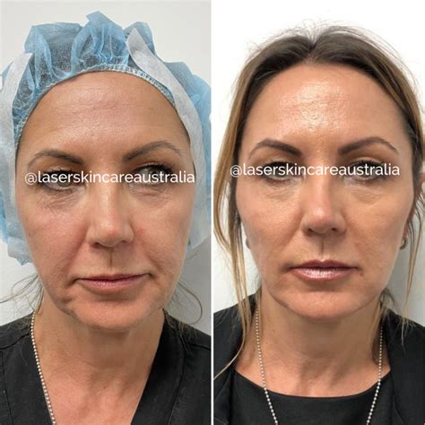 Image result for Thread Removal