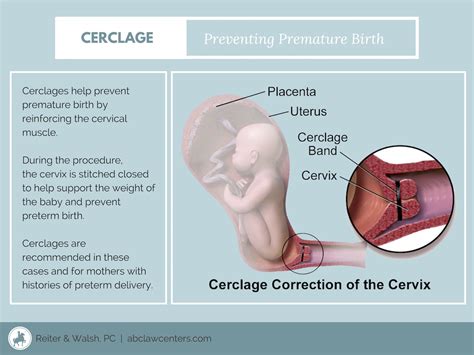 Signs and Symptoms of Incompetent Cervix | ABC Law Centers: Birth ...