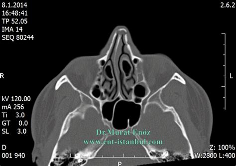 Concha Bullosa - Aerated Turbinate - Definition and Treatment