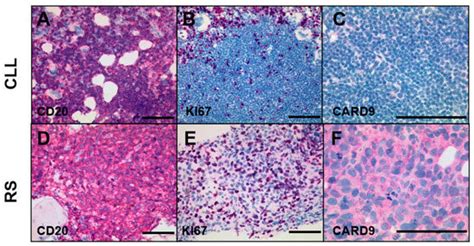 CARD9 Forms an Alternative CBM Complex in Richter Syndrome