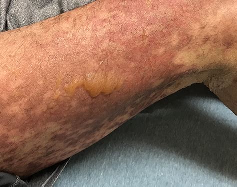 Rash Pictures SJS 的图像结果