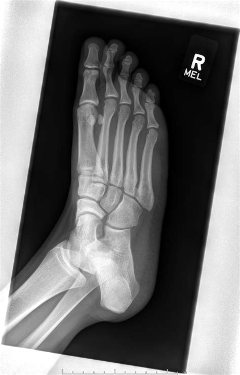Navicular Bone Fracture Boot at Lucy Doak blog