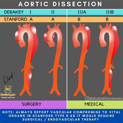 Aortic Dissection | Radiology Reference Article