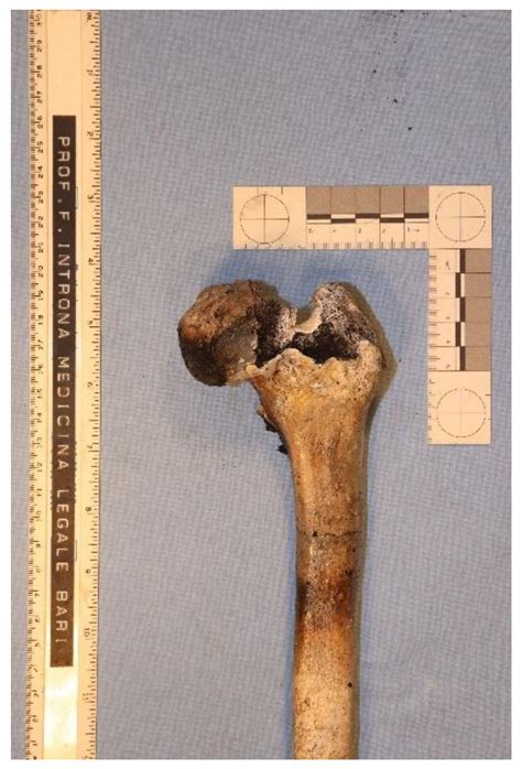 Forensic Expertise Based on Findings through Postmortem Mammography Imaging