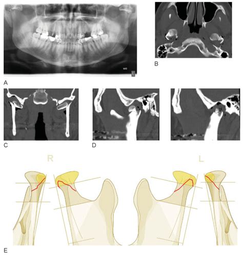The Comprehensive AOCMF Classification System: Condylar Process ...