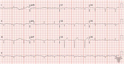 Poor R-wave Progression | ECG Stampede