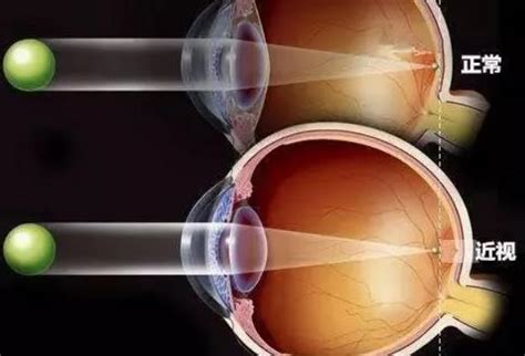 眼睛激光手术有哪些后遗症，术后如何护理？_千颜网