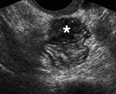 Endometriosis of the Posterior Cul-De-Sac: Clinical Presentation and ...