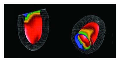 Image result for Iterative Reconstruction Osem