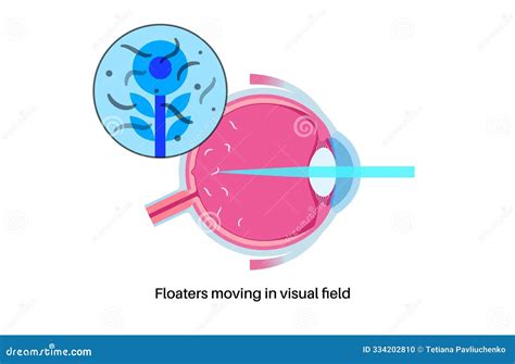 What Improves Eye Floaters
