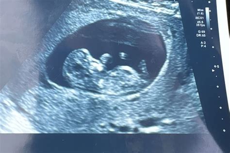 So I’m 11 weeks 1 day and this was baby today heart rate 150 | BabyCenter
