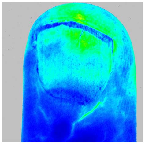 Correlation between Microvascular Damage and Internal Organ Involvement ...