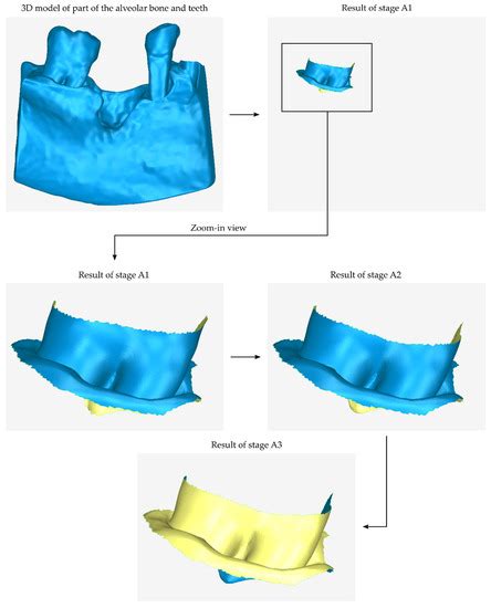 CBCT-Based Design of Patient-Specific 3D Bone Grafts for Periodontal ...