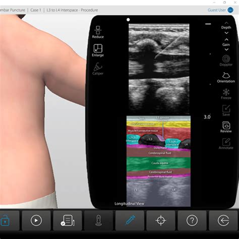 Neonatal Infant Lumbar Puncture Ultrasound Procedure