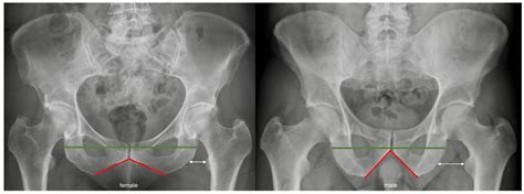 Male Vs Female Pelvis X Ray